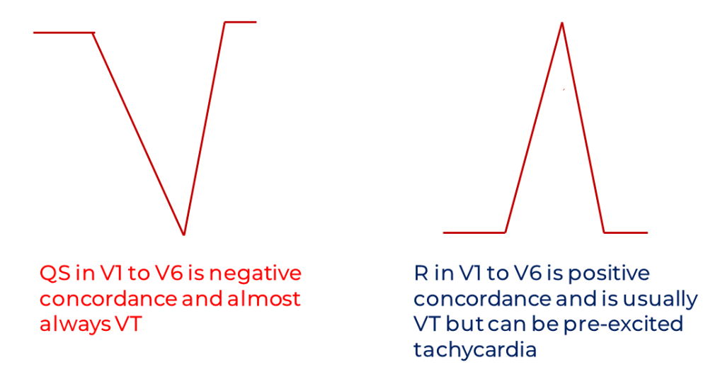 Illustration of Precordial Concordance