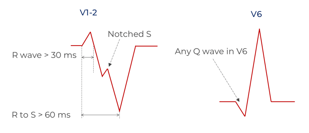 Kindwall criteria for LBBB in V1