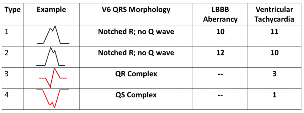Table 5 Configuration in Lead V6 in Patients with LBBB shaped QRS complexes during tachycardia