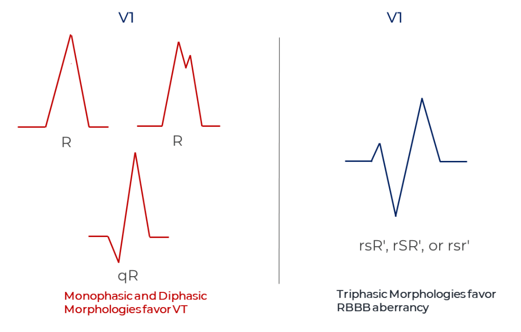 Lead V1 in RBBB observations by Sandler and Marriott
