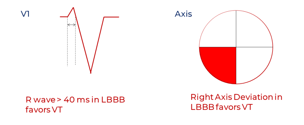 Swanick and Marriott's findings for LBBB morphology